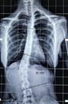 icona RX COLONNA SCOLIOSI
