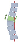 icona SCHEMA INCUNEAMENTO VERTEBRA SCOLIOSI